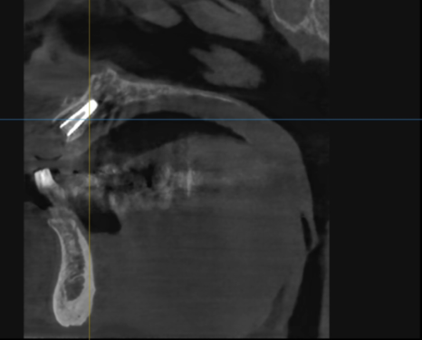 앞니 고름, 잇몸약을 먹어도 왜 염증이 가라앉지 않을까요? 관련 이미지 12