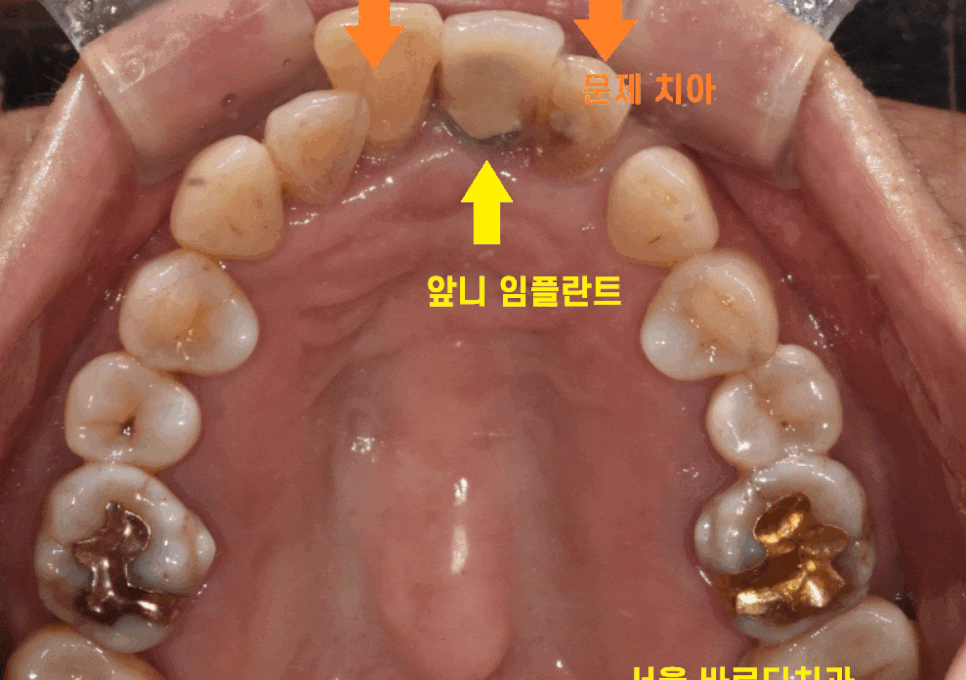미사 임플란트 보철 새로하고 연결했습니다. 관련 이미지 1