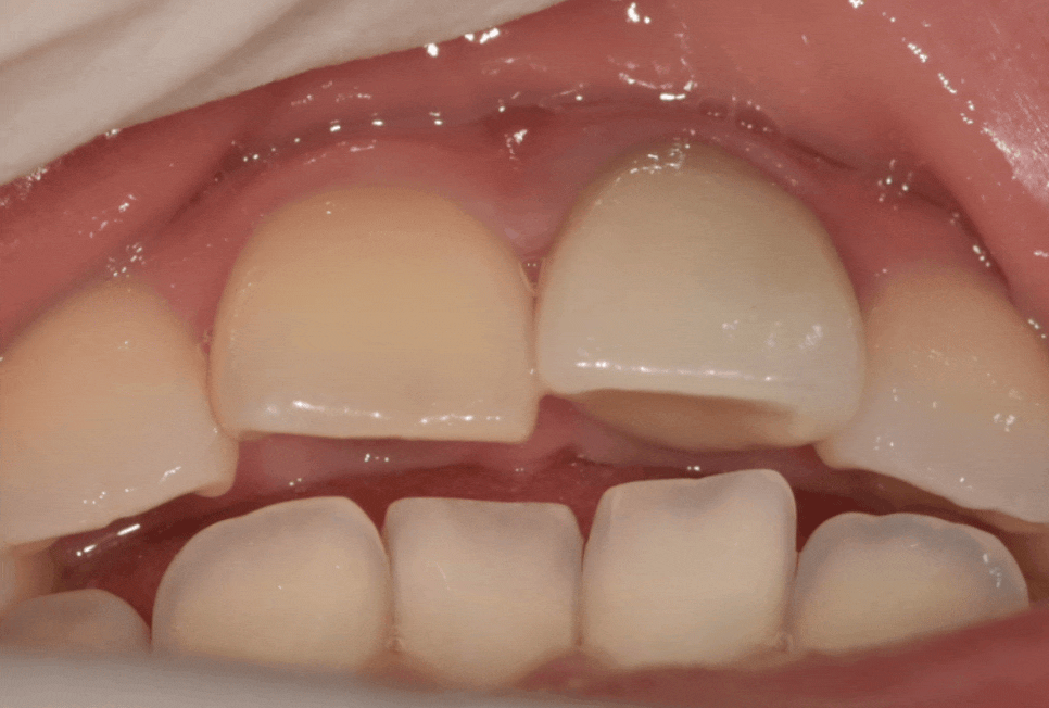 명일동 치과, 잇몸이 검게 변했다면? 앞니 변색 원인은 바로 관련 이미지 15