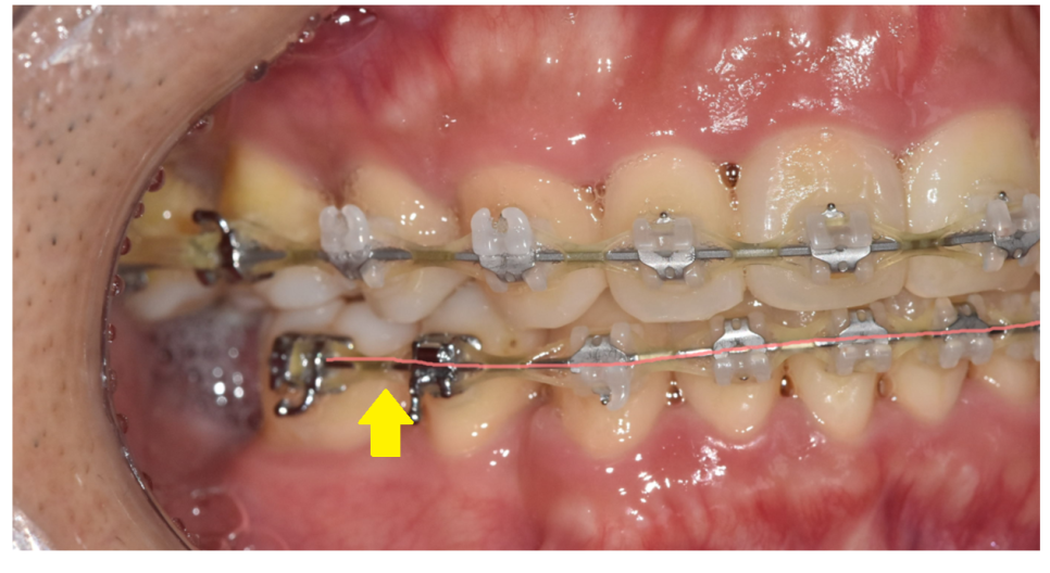교정 철사 교체 와이어 왜 자꾸 갈까? 주기는? 관련 이미지 1