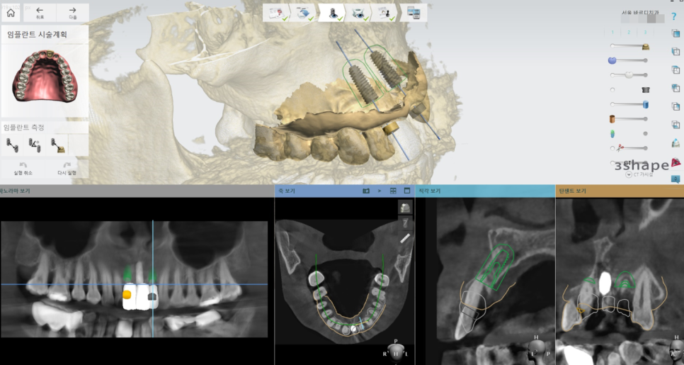 상일동역 치과 윗니 앞니 흔들림 임플란트로 심미까지 잡았습니다. 관련 이미지 9