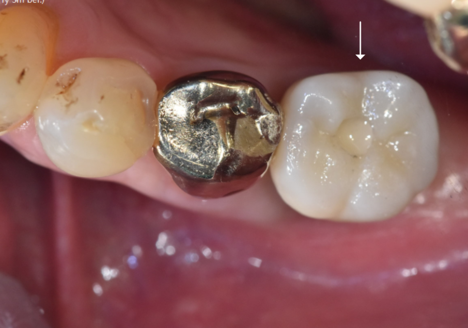 강동구 임플란트 기간, 사람마다 왜 다를까? 즉시식립과 지연식립의 결정적 차이 관련 이미지 17