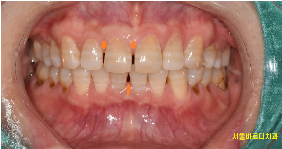 앞니 치아 사이 벌어짐 라미네이트로 컴플렉스 극복! 관련 이미지 1
