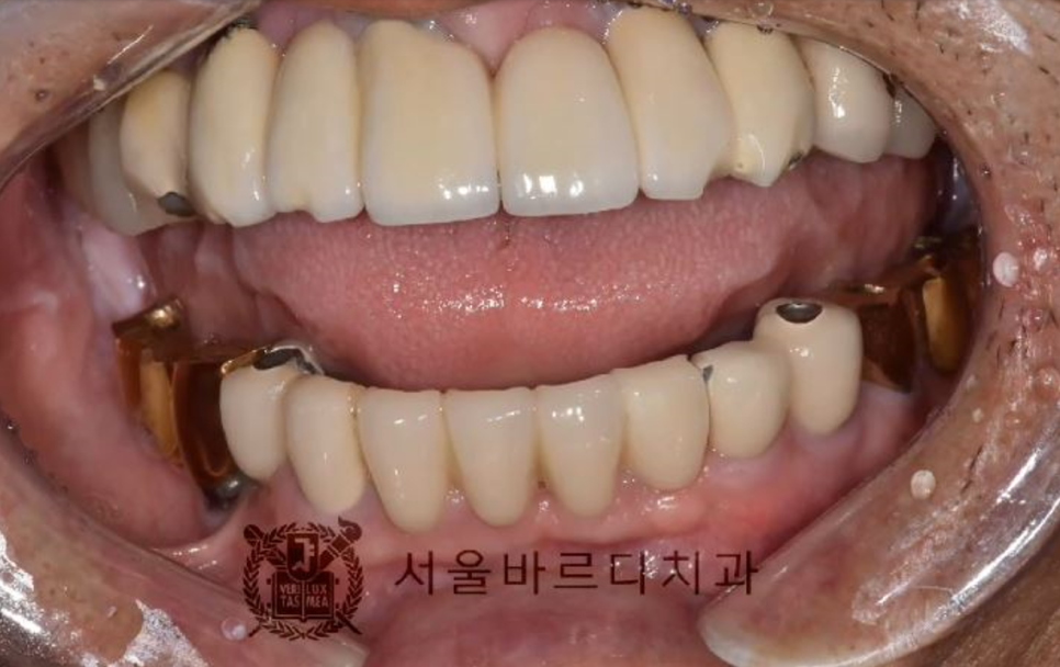 상일동역치과 서울바르디치과 무절개 네비게이션 임플란트 치료증례 #5 관련 이미지 5