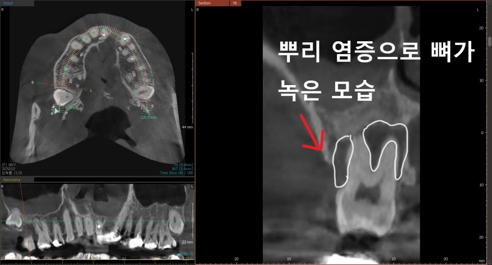 치아 뿌리 염증 빼야 된다는 치아, 이렇게 살렸습니다. 치료 방법 관련 이미지 2