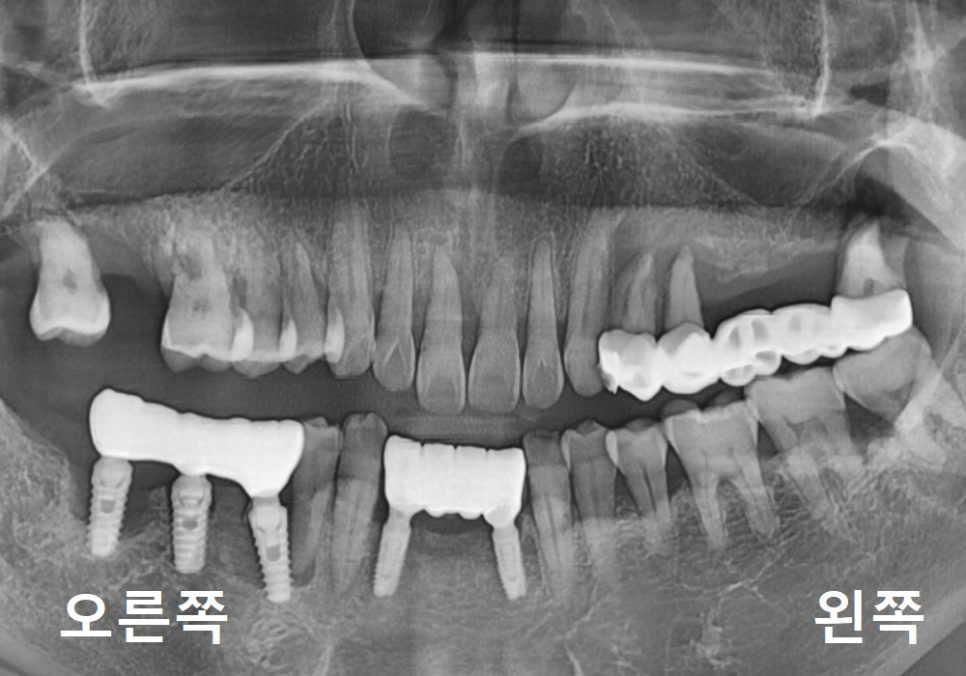 편측 저작, 한쪽으로만 식사하면 결국 이렇게 됩니다. 관련 이미지 4