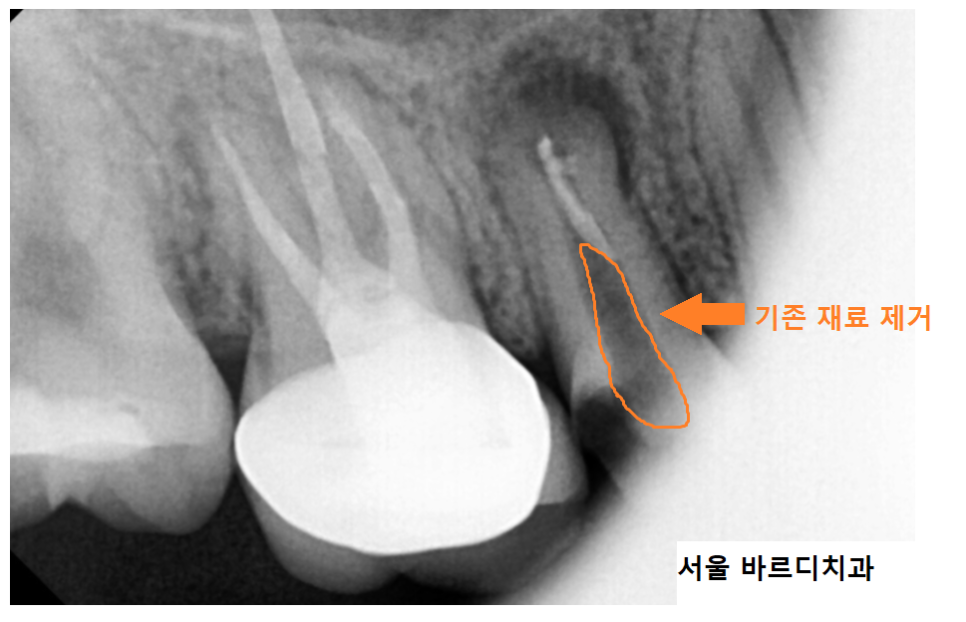 망월동 치과 재신경치료 자연치아 살리기 끝판왕 치료 mta로 가능했습니다. 관련 이미지 6