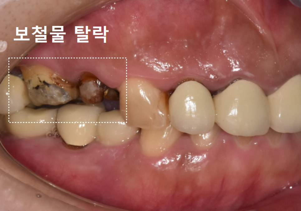 강동구 오래된 보철, 교체 시기는? 아프지 않은데 꼭 바꿔야 하나요? 관련 이미지 6