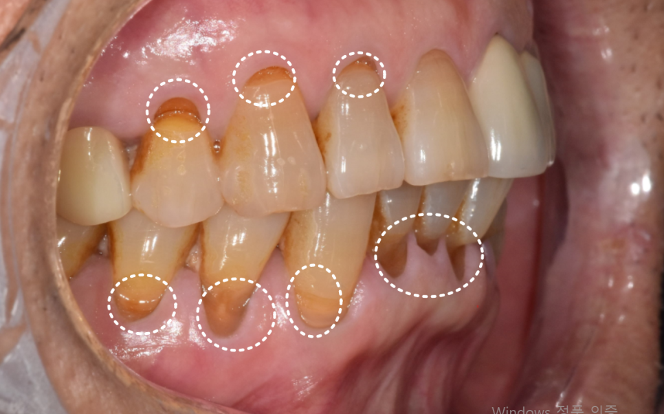 잇몸 내려감으로 길어진 치아, 방치하면 안 되는 원인, 증상, 이유 관련 이미지 2