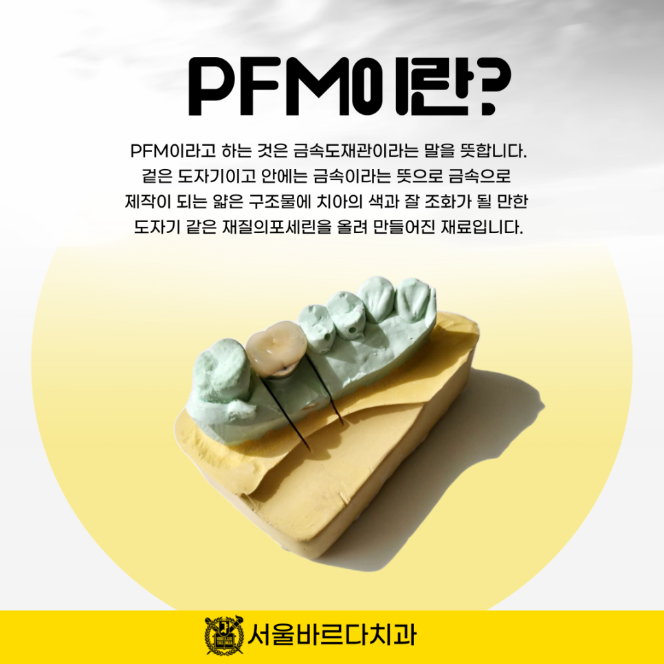 상일동치과 서울바르다치과, 다 똑같은 크라운인지 알았는데 지르코니아와 PFM의 차이를 알고계신가요~? 관련 이미지 4