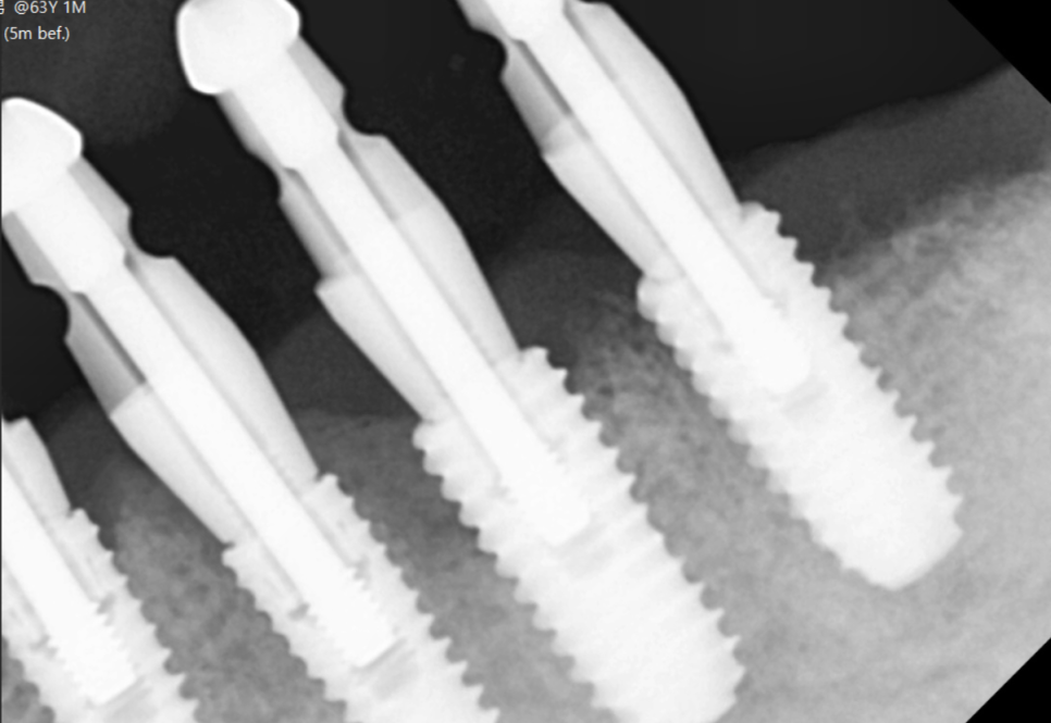 고덕역  치과 틀니쓰다 위아래 전악 임플란트 재건했습니다. 관련 이미지 10