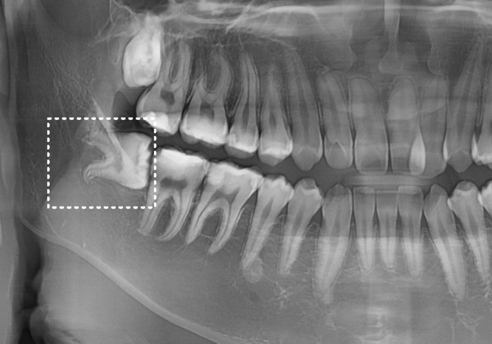 고덕동 사랑니 매복 발치, 안 아픈데 꼭 빼야 하나요? 관련 이미지 2