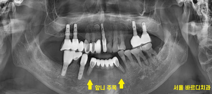 강동구 치과 앞니 흔들림 임플란트 케이스 관련 이미지 3