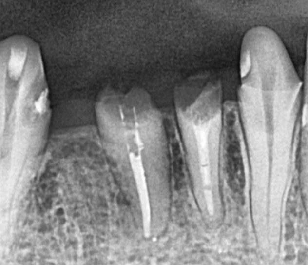 Honestly, Can an Unbroken Temporary Tooth Be Used Without a Crown? image 1