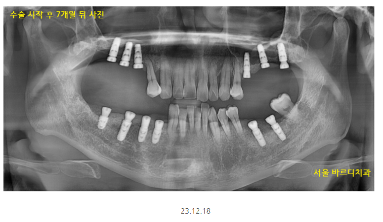 길동 치과 임플란트 뼈이식 흡연 관련 있을까? 관련 이미지 9