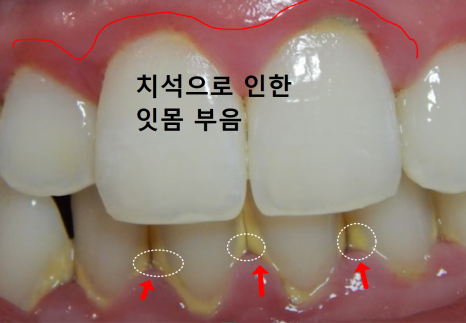 스케일링했더니 잇몸 구멍, 치아 사이 구멍이 생겼어요. 스케일링에 관한 오해 3가지 관련 이미지 6