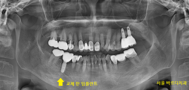 풍산동 치과 임플란트 염증으로 교체 한 환자분 케이스 관련 이미지 9