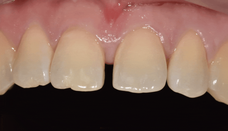 고덕동 치간 이개, 위 앞니 벌어짐, 교정? 라미네이트? 고민이시라면 필독 관련 이미지 13