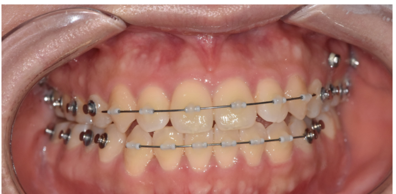 고덕동 투명교정 인비절라인도 철사를 붙일 수 있습니다. 관련 이미지 4