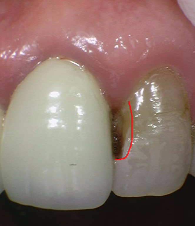 미사역 치과 앞니 충치 레진으로 당일 수복 완료하였습니다. 관련 이미지 5