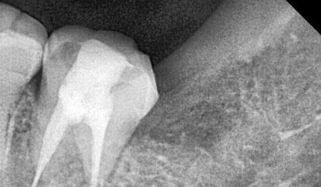 상일동 사랑니 매복 방치하다 옆 치아까지 망가진 실제 사례 관련 이미지 15