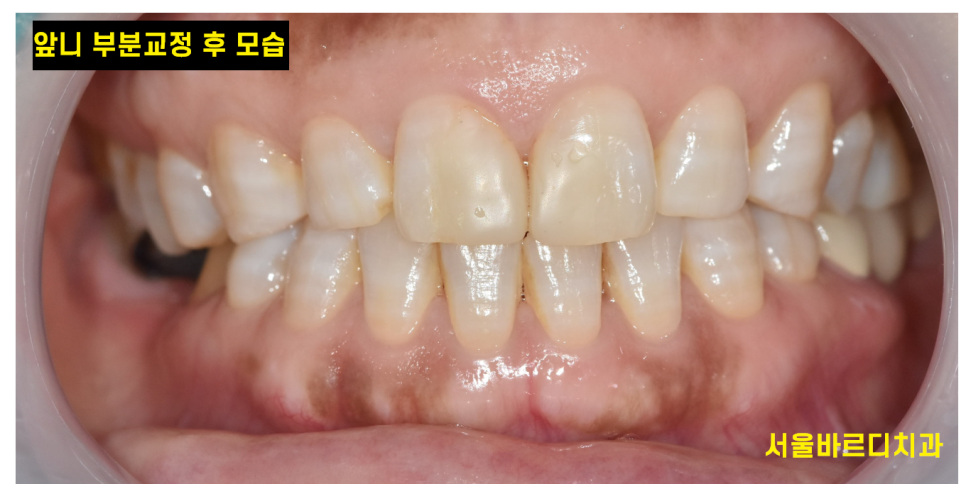 고덕동 교정치과 앞니 사이 틈 부분교정으로 치아 삭제없이 공간 없애기 관련 이미지 6