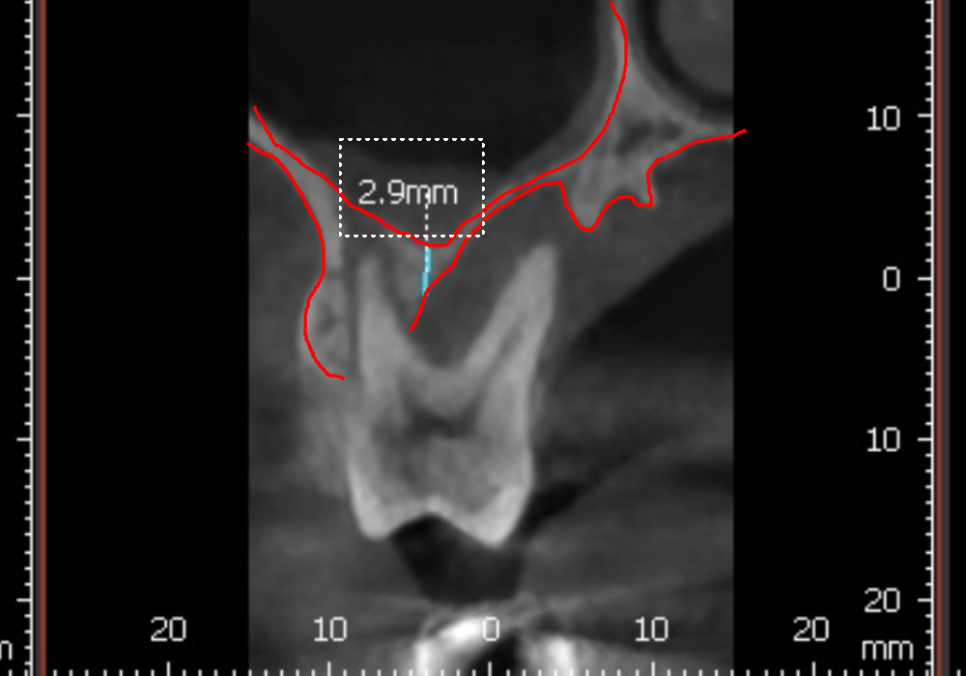 상악동 거상술 부작용 걱정되시나요? 재수술 없는 뼈이식의 정석 공개 관련 이미지 9