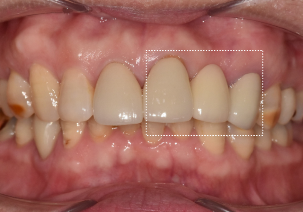 오래된 앞니 크라운 냄새, 관련 이미지 3