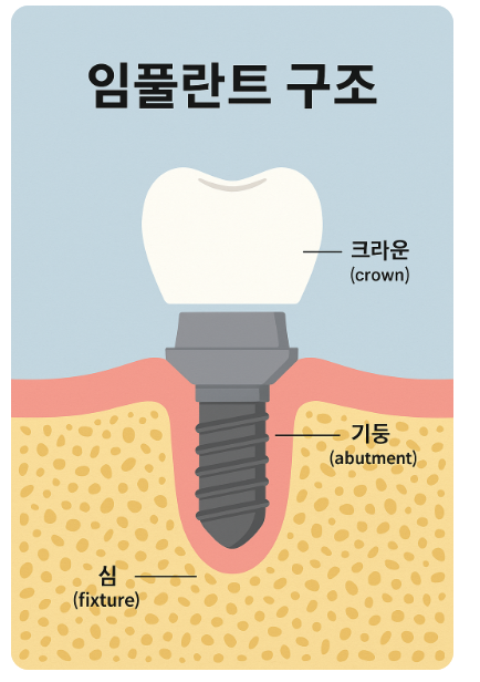 상일동 치과 임플란트 심 박는 것이 무엇인가요? 관련 이미지 1
