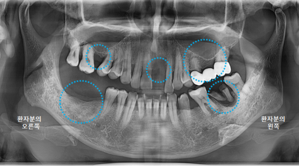 고덕동치과 서울바르디치과 전치부 및 구치부 임플란트 치료증례 #9 관련 이미지 2