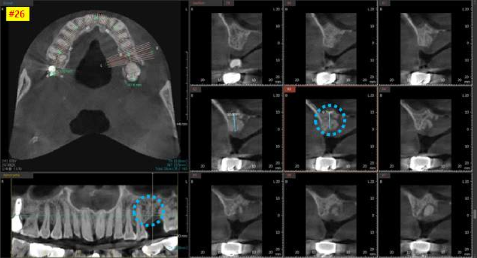 서울바르디치과 상하악 대구치 네비게이션 임플란트 치료증례 #4 관련 이미지 5