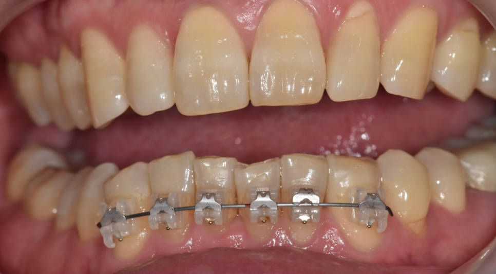 교정은 어릴 때 해야 한다? 성인과 청소년 교정, 뭐가 다를까? 관련 이미지 4