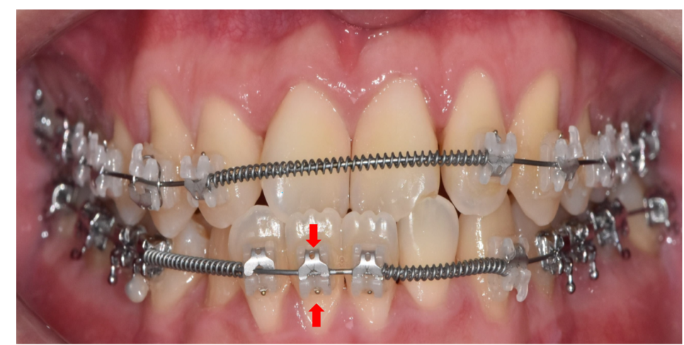 자가결찰 브라켓 빠르게 끝내고 통증은 줄여서 관련 이미지 3