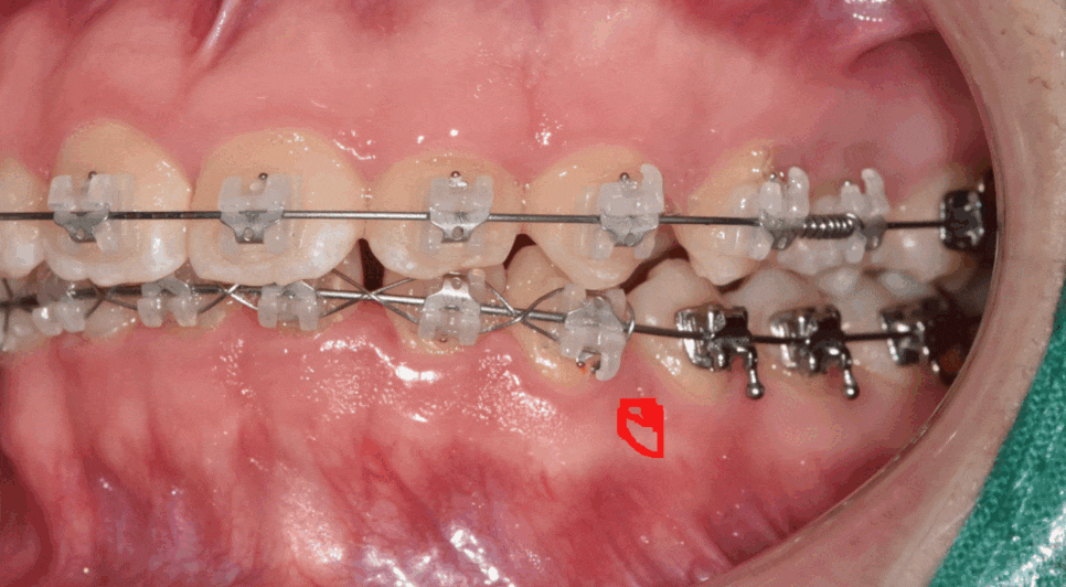 Answering Your Questions About Orthodontic Mini-Screw Placement. (Q&A) image 1