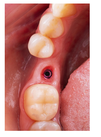 비절개 임플란트 추구하는 3가지 이유 관련 이미지 4
