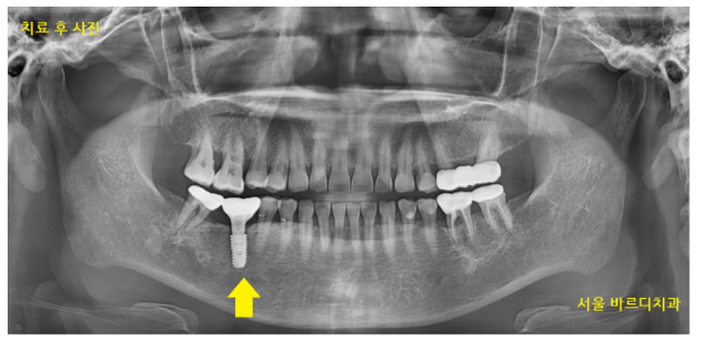 강동구 치과 약먹는게 많은데 임플란트 수술 할 수 있나요?? 관련 이미지 8