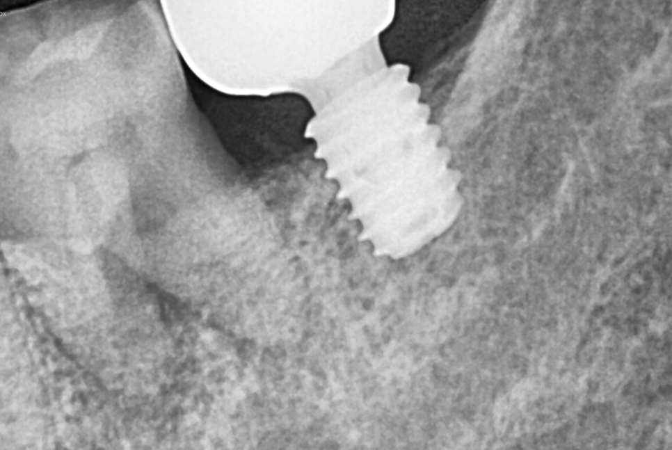 씹을때 찌릿 치아균열증후군 보이지 않아 위험합니다. 관련 이미지 2