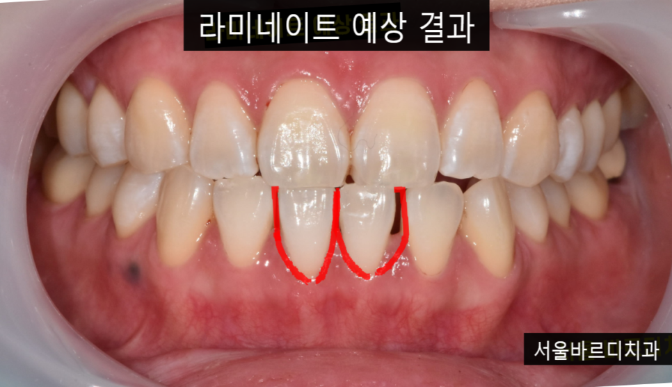 벌어진 아래 앞니 라미네이트로 감쪽같게 치료했습니다. 관련 이미지 5