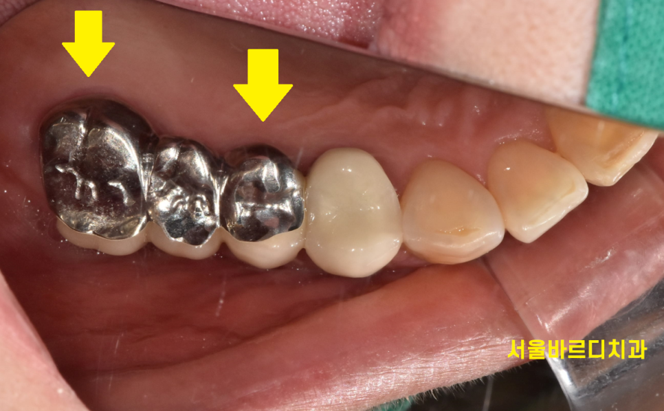 보철 부러짐 발생으로 치아 뿌리만 남았을 때 치료 방법 임플란트 관련 이미지 4
