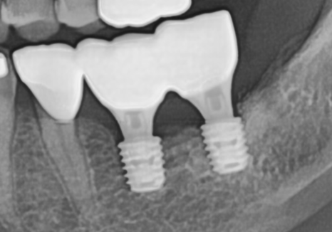 Sangil-dong Station Implant Visits: How Many Times Do You Actually Need to Go to the Dentist? image 9