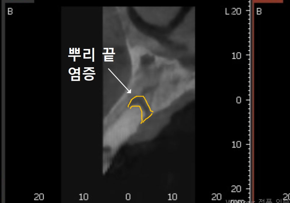 강동구 앞니 충치, 누구는 레진이고 누구는 임플란트인 관련 이미지 5