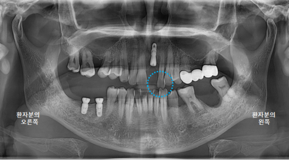 고덕동치과 서울바르디치과 전치부 및 구치부 임플란트 치료증례 #9 관련 이미지 7