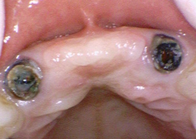 앞니 잇몸 검은색 라인 오래된 pfm 보철 교체하세요!! 관련 이미지 8