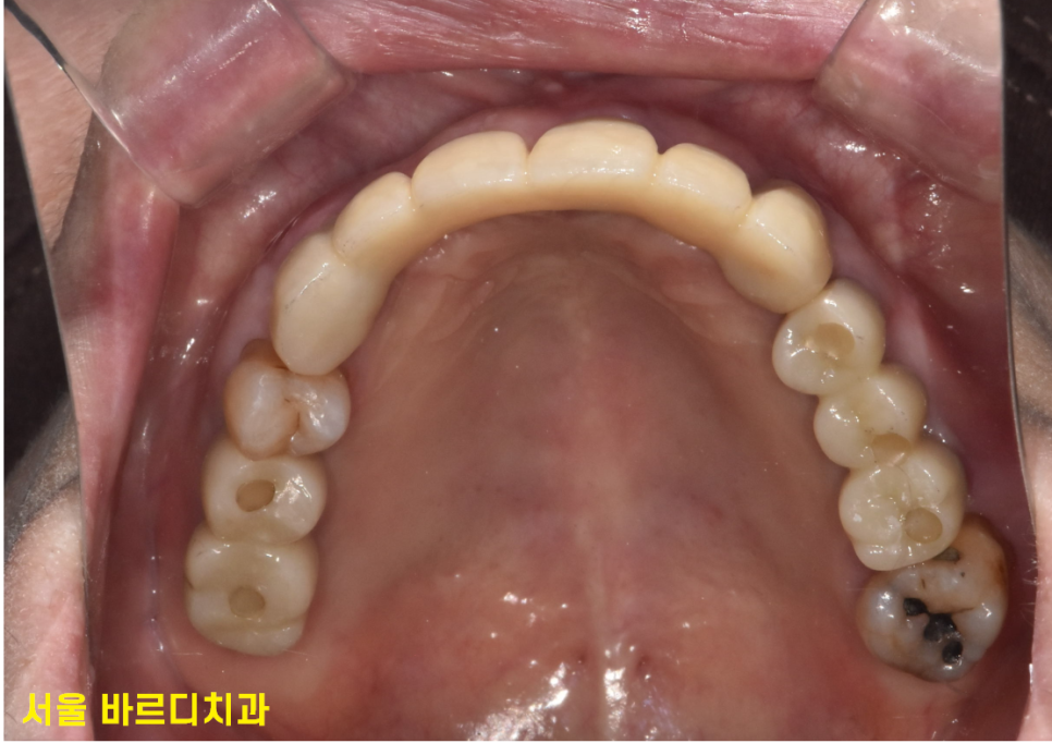 전체적인 치아 치료 13개의 임플란트를 식립한 환자분 관련 이미지 14