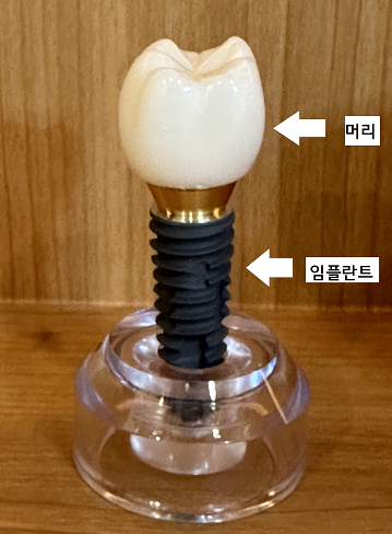임플란트 기둥 맞춤으로 어느 한 과정도 놓칠 수 없으니까! 관련 이미지 2