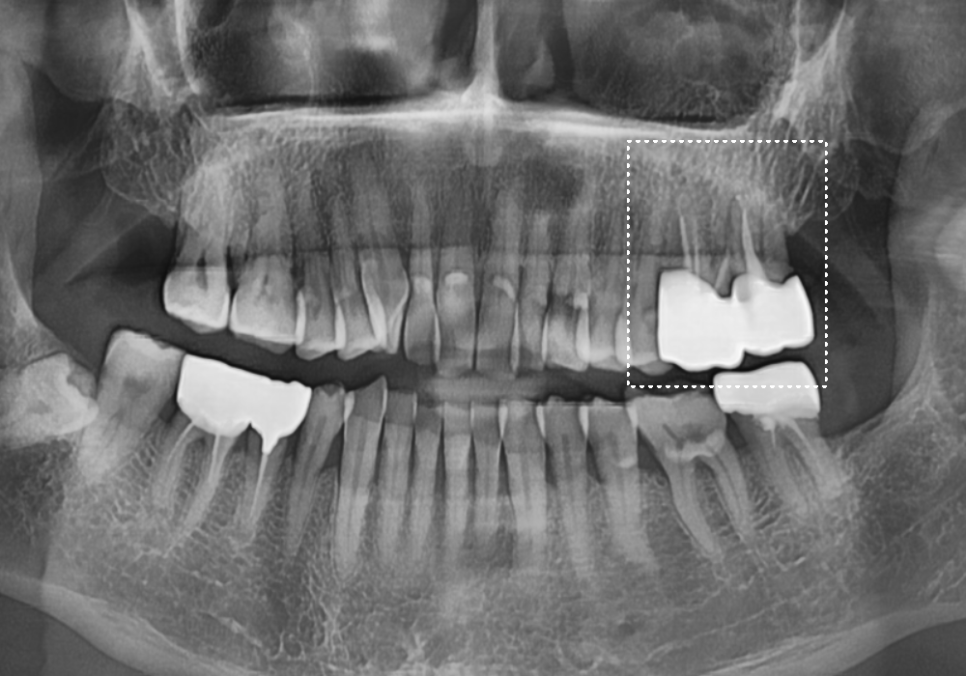 어금니 금 감, 치아 살릴 수 있는 기준은 바로 관련 이미지 10