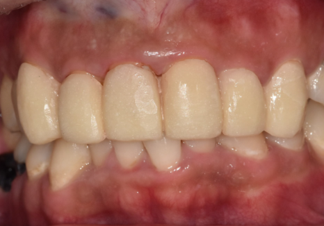 A Single Black Spot of Decay Between the Front Teeth May Be a Warning Sign of Multiple Cavities. image 10