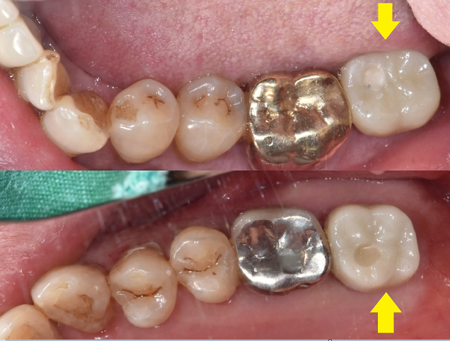 강동구 임플란트 위 아래 어금니 동시 식립으로 치료기간 대폭 축소 관련 이미지 8