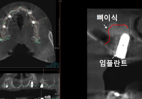 뼈가 없어서 안 된다구요? 70대 당뇨 무치악 환자분의 전체 임플란트 사례 관련 이미지 11