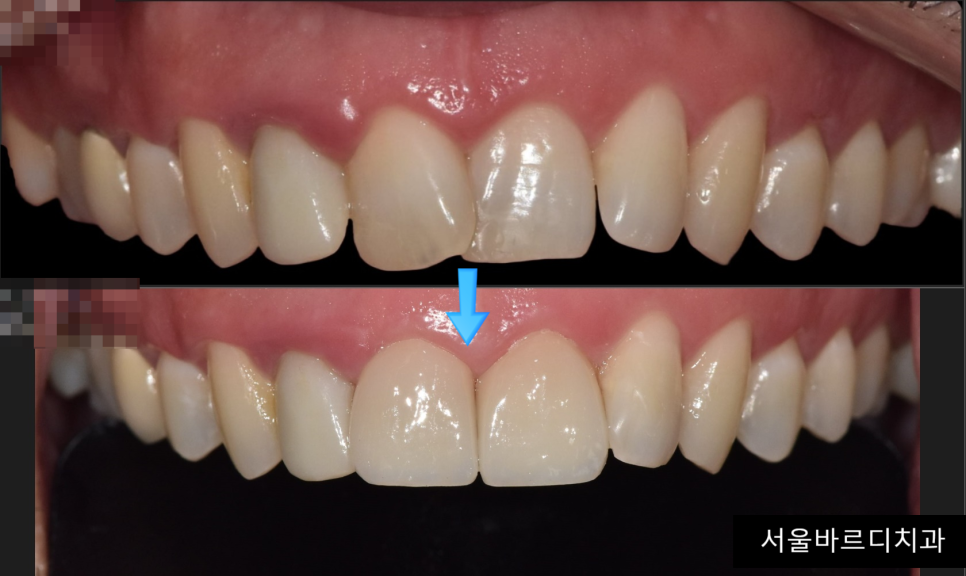 상일동 라미네이트 과연 진짜 안좋을까??? 교정, 크라운과 비교해보았습니다!! 관련 이미지 1